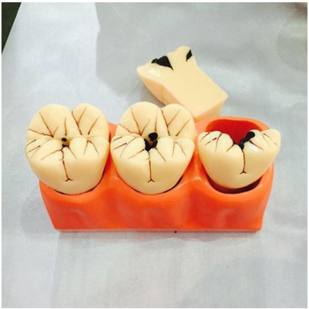 Mô hình răng sâu 4 cái - Vật Tư Nha Khoa Thiên Nam - Công Ty TNHH Vật Tư Nha Khoa Thiên Nam